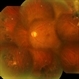 Xenon Photocoagulation Marks in Vasculitis Xenon Photocoagulation Marks in Vasculitis