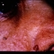 Tuberous Sclerosis Tuberous Sclerosis