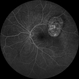 Choroidal Melanoma Choroidal Melanoma