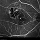 Polypoidal Choroidal Vasculopathy (FA Early Phase) Polypoidal Choroidal Vasculopathy (FA Early Phase)