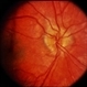 Peripapillary CNVM / Uveitis Peripapillary CNVM / Uveitis