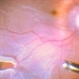 Retinal Detachment with a Posterior Tear Retinal Detachment with a Posterior Tear