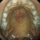 Oral Ulcers in Behcet's Disease Oral Ulcers in Behcet's Disease