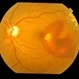 Subfoveal Bleed From Extramacular CNVM