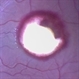 Sub ILM Hemorrhage