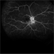Chorioretinal Inflammation Chorioretinal Inflammation