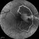 Central Retinal Artery Occlusion & Cilioretinal Artery Sparing Central Retinal Artery Occlusion & Cilioretinal Artery Sparing