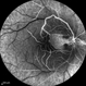 Central Retinal Artery Occlusion & Cilioretinal Artery Sparing Central Retinal Artery Occlusion & Cilioretinal Artery Sparing