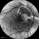 Central Retinal Artery Occlusion & Cilioretinal Artery Sparing Central Retinal Artery Occlusion & Cilioretinal Artery Sparing