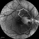 Central Retinal Artery Occlusion & Cilioretinal Artery Sparing Central Retinal Artery Occlusion & Cilioretinal Artery Sparing