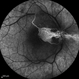 Central Retinal Artery Occlusion & Cilioretinal Artery Sparing Central Retinal Artery Occlusion & Cilioretinal Artery Sparing