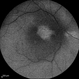 Central Retinal Artery Occlusion & Cilioretinal Artery Sparing Central Retinal Artery Occlusion & Cilioretinal Artery Sparing
