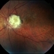 Astrocytic Hamartoma