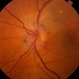 Anterior Ischemic Optic Neuropathy and Choroidal Ischemia Anterior Ischemic Optic Neuropathy and Choroidal Ischemia