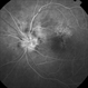 Anterior Ischemic Optic Neuropathy and Choroidal Ischemia