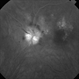 Anterior Ischemic Optic Neuropathy and Choroidal Ischemia