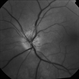 Anterior Ischemic Optic Neuropathy (AION) Anterior Ischemic Optic Neuropathy (AION)