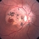 Traumatic Macular Hole Traumatic Macular Hole