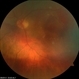 AMD with Subretinal  Hemorrhage OS AMD with Subretinal  Hemorrhage OS