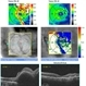 AMD and Subretinal Heme Pre- and Post-Op tPA AMD and Subretinal Heme Pre- and Post-Op tPA