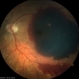 AMD with  Subretinal Hemorrhage Recurrence OS AMD with  Subretinal Hemorrhage Recurrence OS