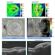 AMD and Subretinal Heme Recurrence AMD and Subretinal Heme Recurrence