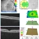 Acute Macular Neuroretinopathy OD Acute Macular Neuroretinopathy OD