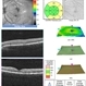 Acute Macular Neuroretinopathy OS Acute Macular Neuroretinopathy OS