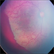 Aggressive Posterior Retinopathy of Prematurity (AP-ROP) Aggressive Posterior Retinopathy of Prematurity (AP-ROP)