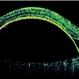 Advanced Wet AMD Advanced Wet AMD