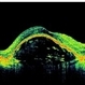 Advanced Wet AMD Advanced Wet AMD