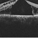 OCT Optic Pit Maculopathy Preop
