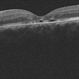 OCT Optic Pit Maculopathy Post-op