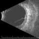 Choroidal Metastasis B-Scan