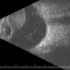 Ciliary Body Melanoma B-Scan Ultrasound Ciliary Body Melanoma B-Scan Ultrasound