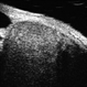 Ciliary Body Melanoma-UBM Ciliary Body Melanoma-UBM