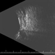 Sturge-Weber B Scan Post-Radiation