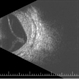 Sturge-Weber Diffuse Hemangioma and Retinal Detachment on B-scan