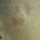 Sturge-Weber Skin Photo