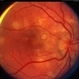 Acute Posterior Placoid Pigment Epitheliopathy Acute Posterior Placoid Pigment Epitheliopathy