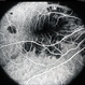 APMPPE, Fluorescein Angiography