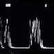 Choroidal Hemangioma