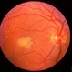 Adult Vitelliform Dystrophy
