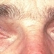 Siderosis