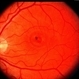 Central areolar atrophy