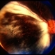 Myelinated Nerve Fibers and Possibly Posterior Staphyloma Myelinated Nerve Fibers and Possibly Posterior Staphyloma
