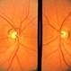 Superior Crescent Optic Nerve Superior Crescent Optic Nerve