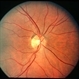 Superior Crescent Optic Nerve Superior Crescent Optic Nerve