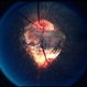 Optic Nerve Malformation Optic Nerve Malformation
