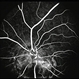 Optic Nerve Malformation Optic Nerve Malformation